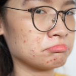 Don’t Let Acne Turn Into a Nightmare!