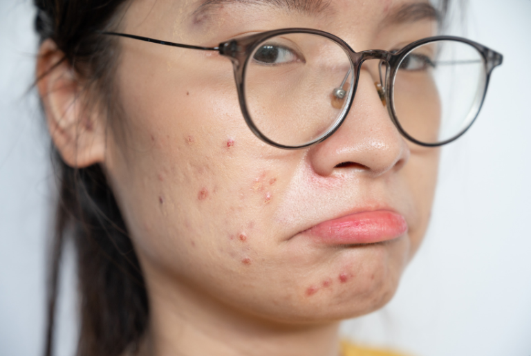 Don’t Let Acne Turn Into a Nightmare!